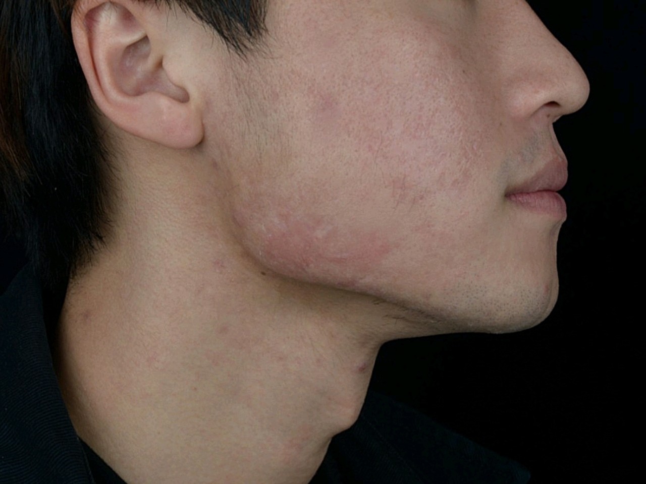 以前青春期长痘导致我两边下颌处各有一片的痘疤增生,_圈子-新氧美容
