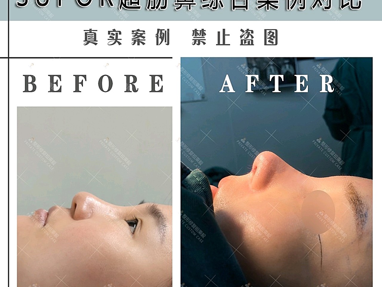 超肋隆鼻