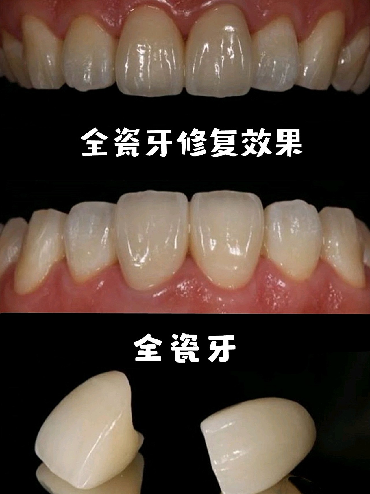 让牙齿恢复最初的面貌和功能",而这个"套上的硬壳"指的就是修复牙冠