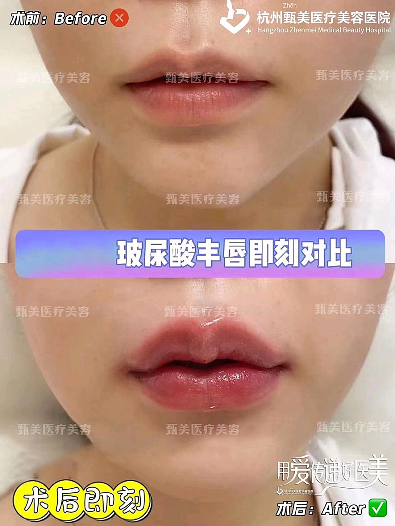 玻尿酸丰唇~[玫瑰]