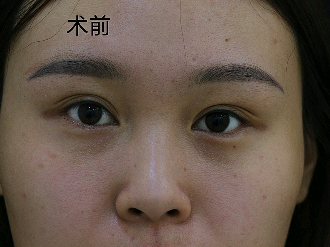 【切开双眼皮】【芭比眼/初生眼/无辜眼】『分层剥离&