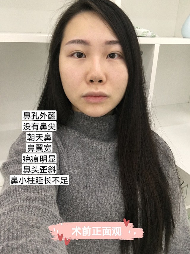 鼻孔外翻一招就变美