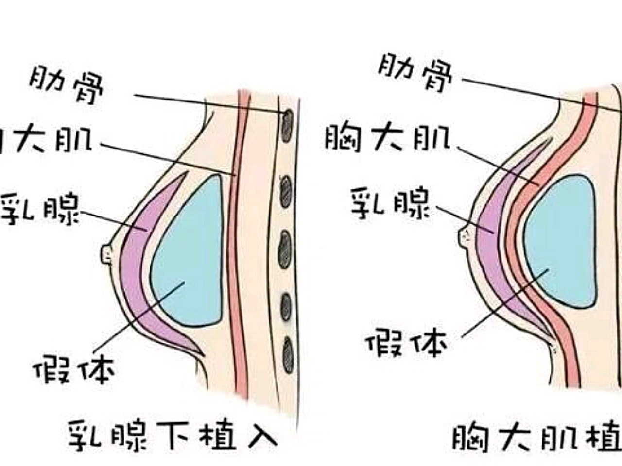 隆过胸的女人能正常哺乳吗?乳汁正常吗?