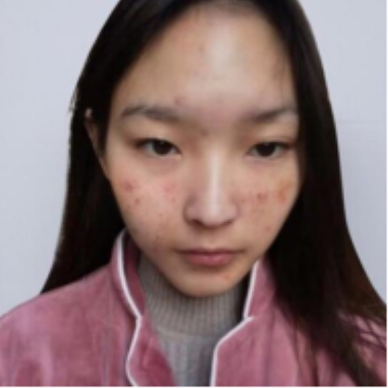 明明长得还行就是痘痘脸硬是拉低了,感觉每次洗脸后看_圈子-新氧美容