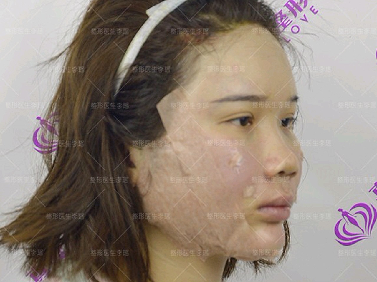 【颧骨微凸的女孩,造成颧骨凸出的就是她的脸颊凹陷问题】
