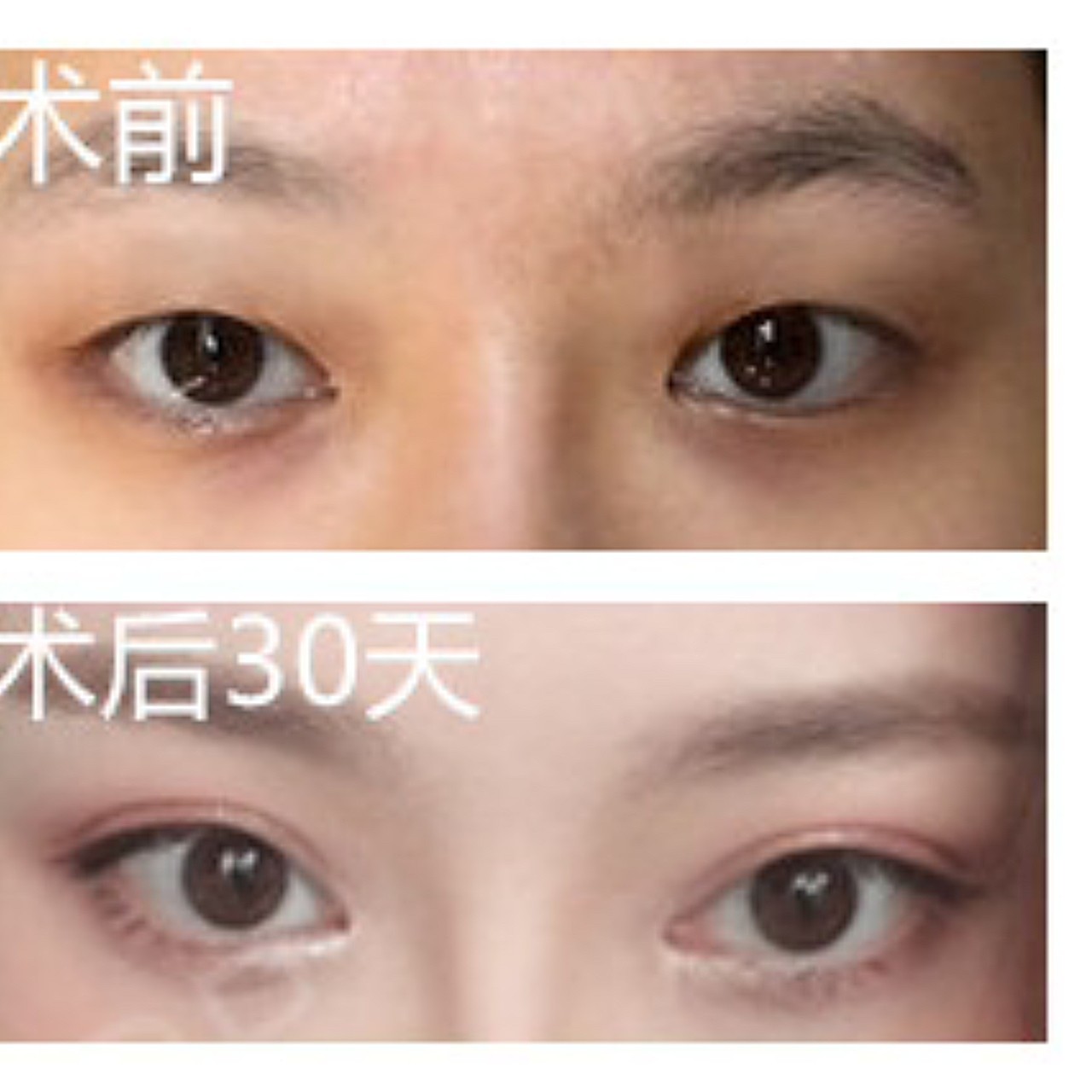 【眼部多项】北大名医亲诊·眼部多项五项·五天拆线隐痕自然不留疤