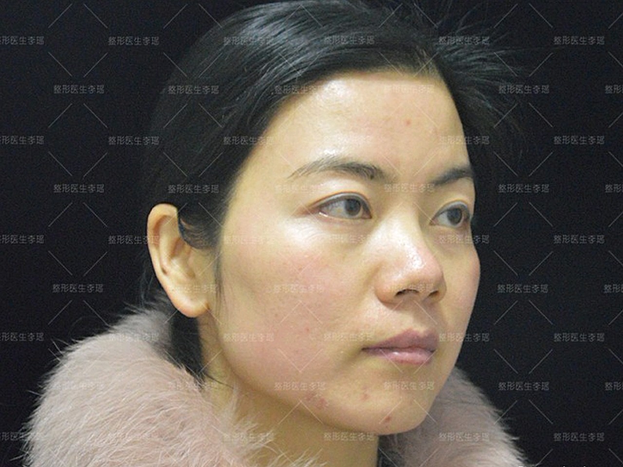 偏菱形脸型的求美者太阳穴凹陷额头不饱满导致脸型上窄下宽轮廓有曲折
