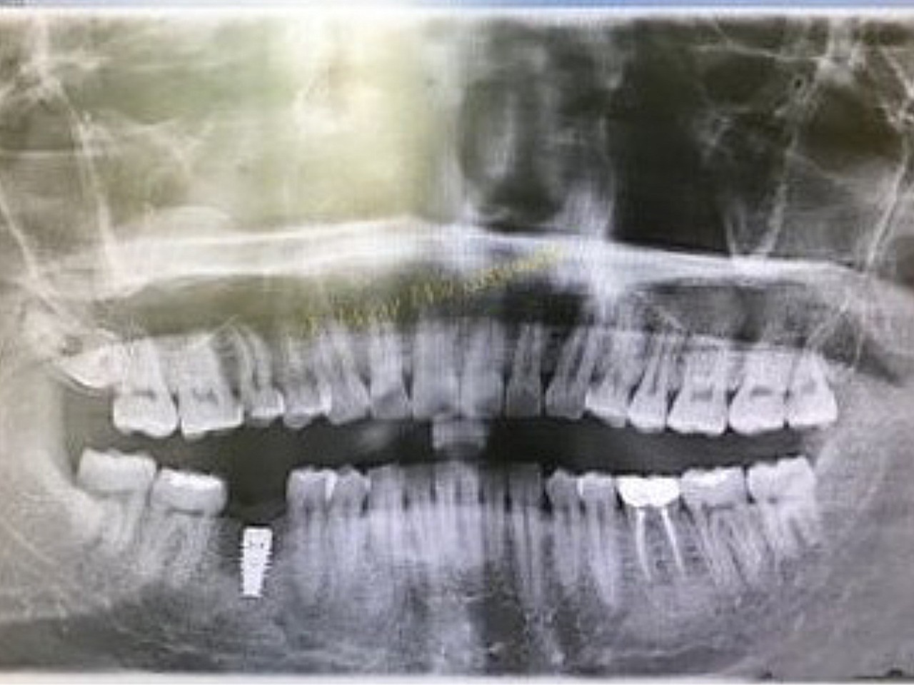 拔牙后的两个月终于有空来安排种植牙的一期治疗了,约_圈子-新氧美容