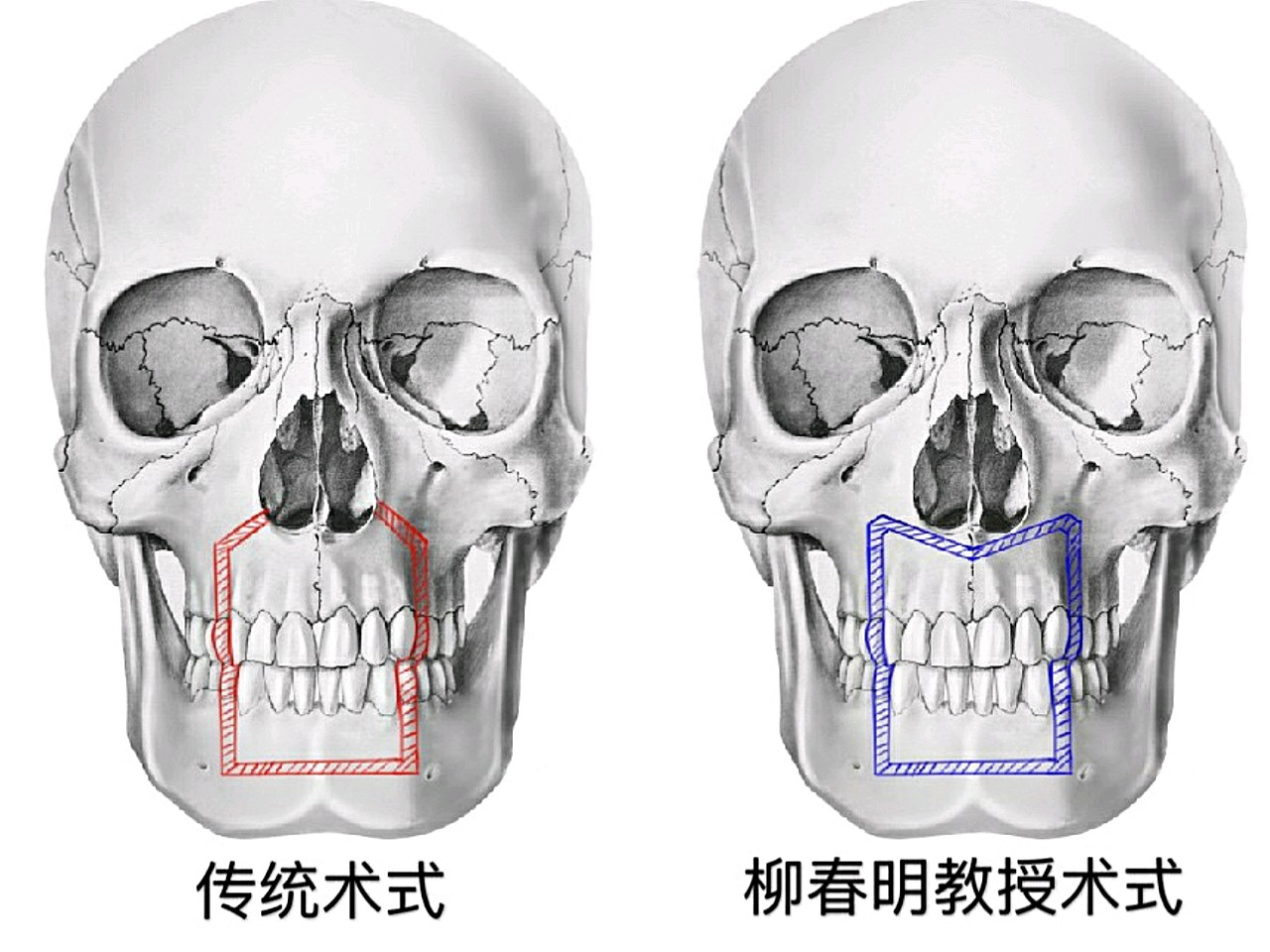 针对骨性凸嘴的人群,我矫正凸嘴的方法是匀梯度和三维方向调整方法