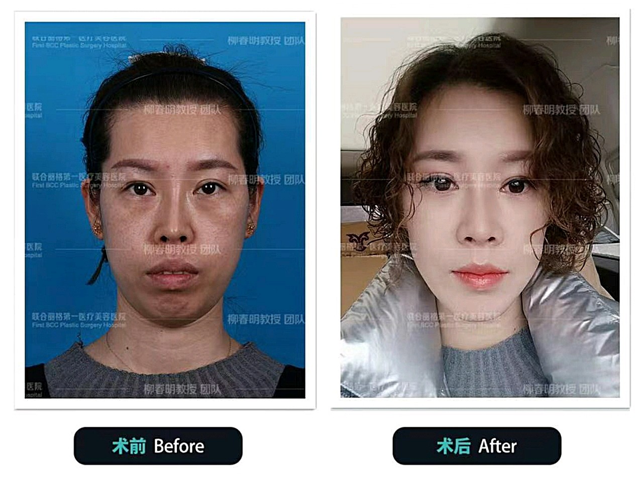 凹凸嘴