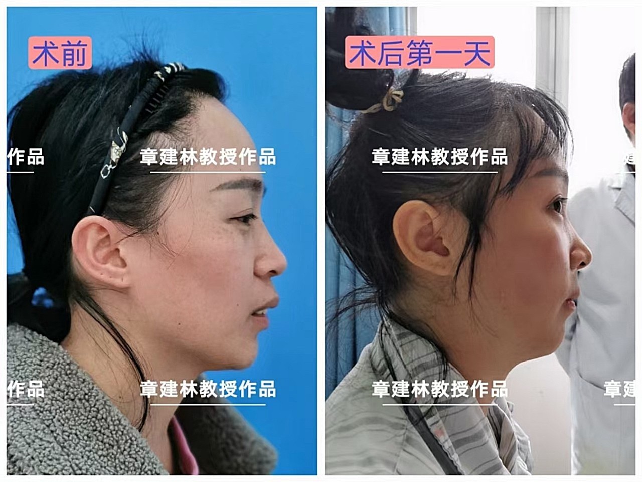 正颌手术 突嘴手术#硬核换头真人改造