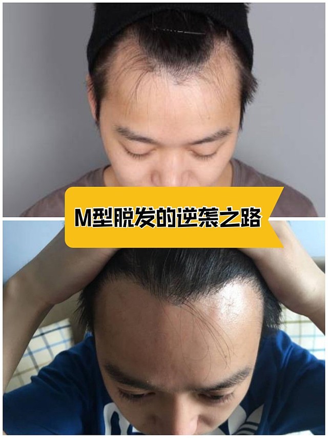 男士m型脱发是指脱发人士从额头开始向后逐渐脱落形成
