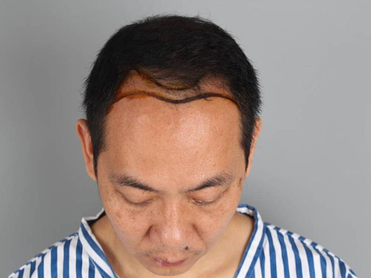 m型脱发男生中出现很多的发际线后移类型