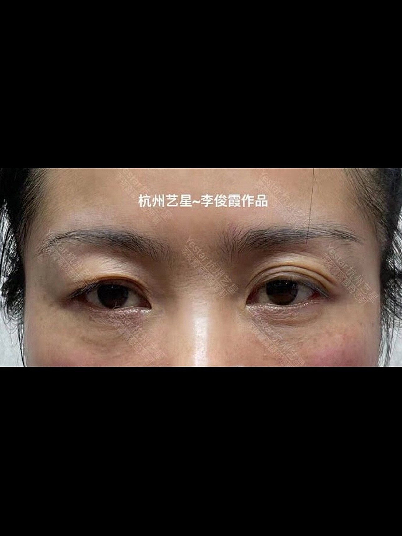 术前双眼皮下垂且多层眼皮无卧蚕