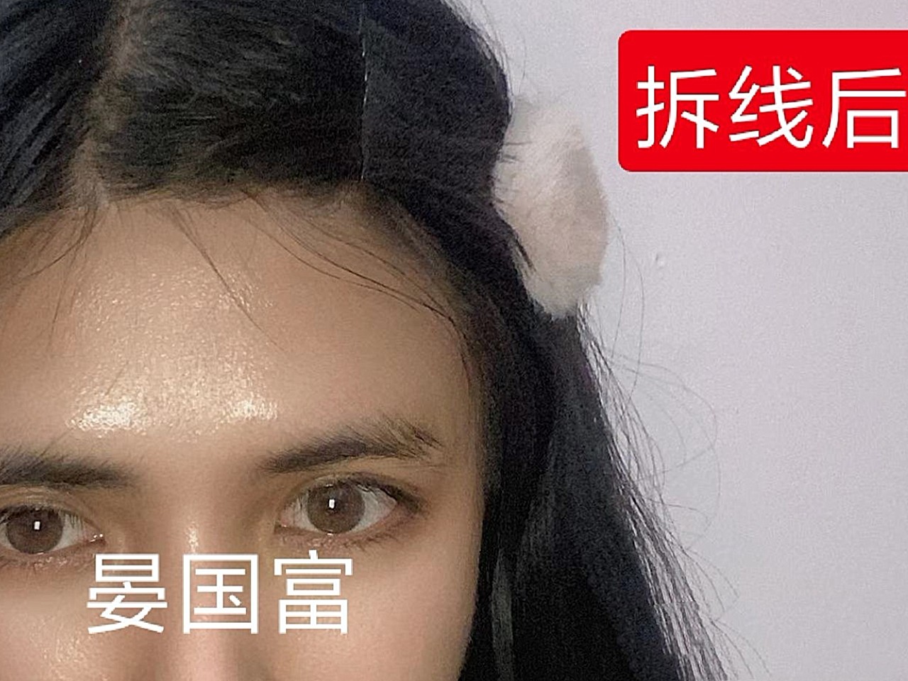 05本身眉眼距离较近的姑娘想做膨体眉弓