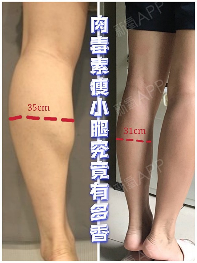 注射瘦腿针999999小腿从35cm到31cm,效果真_圈子-新氧萌葺整形