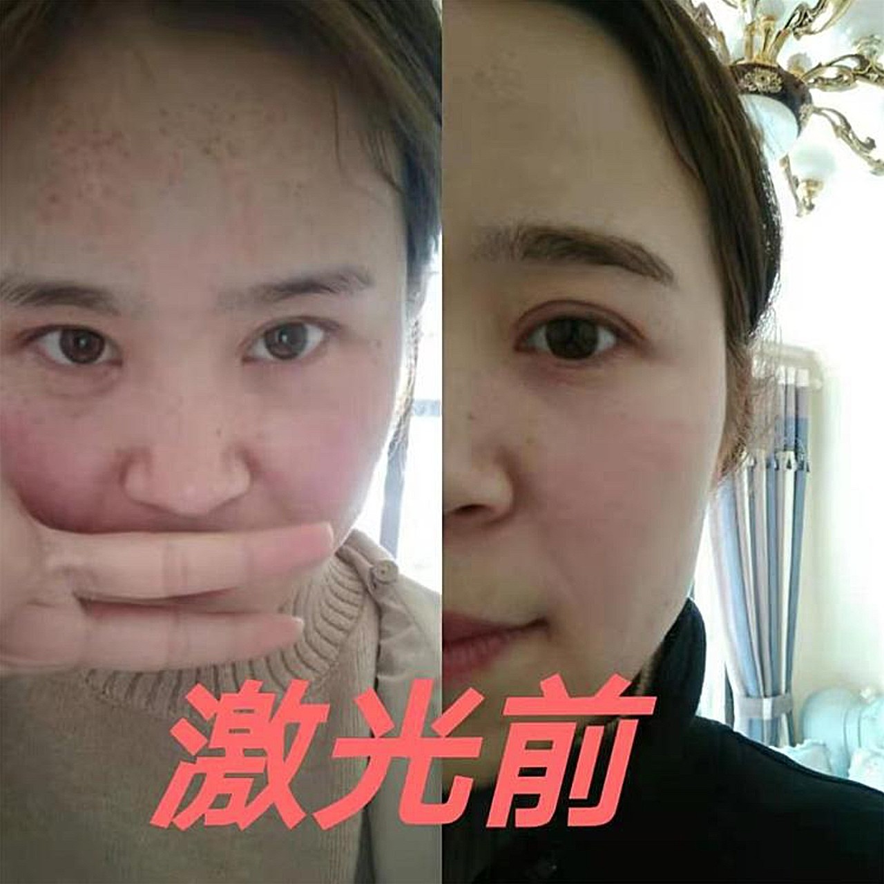 9696普通的面部色斑已经