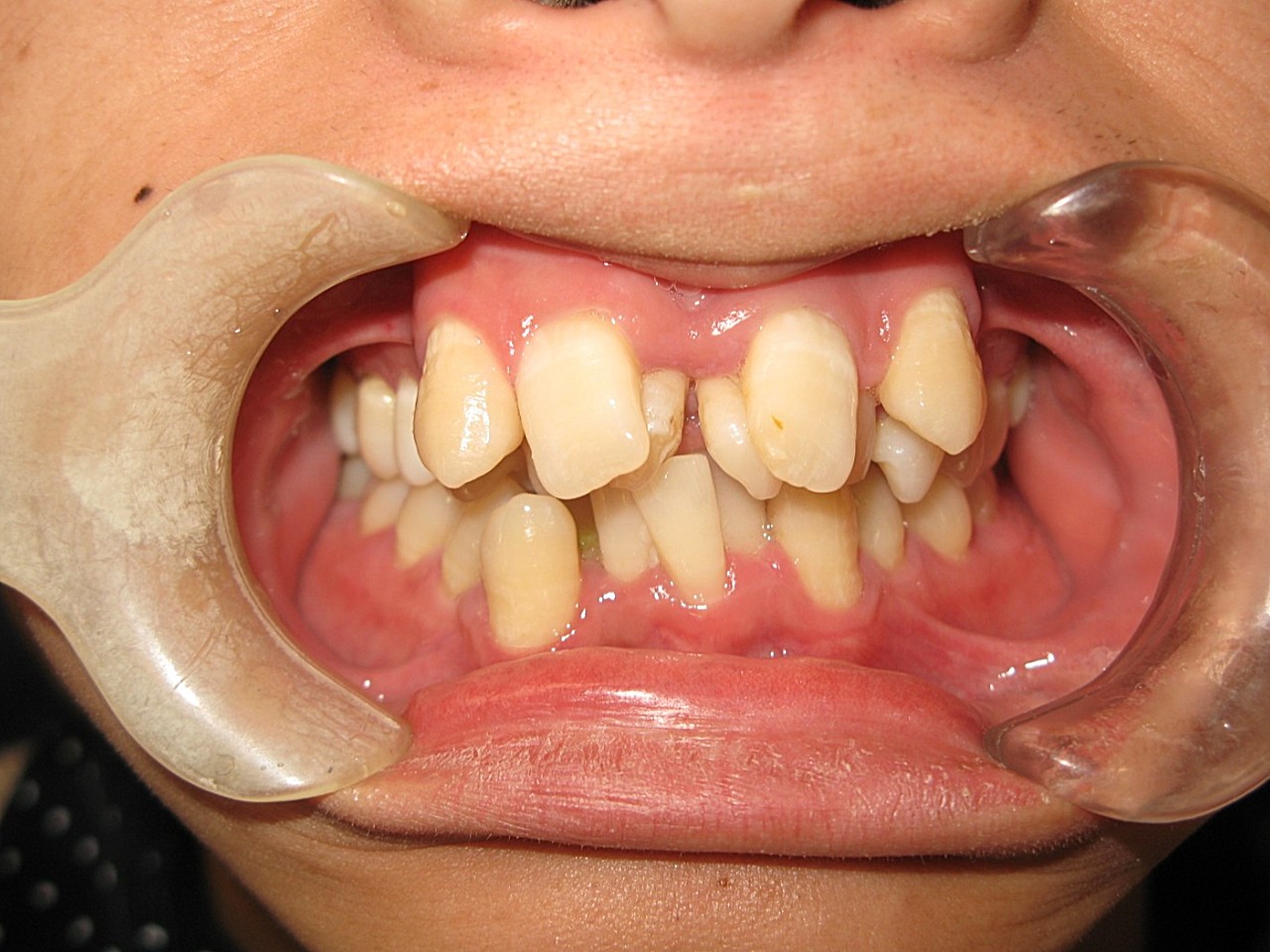 术前诊断这样的牙齿拥挤你见过吗口腔分为上颚和下颚,_圈子-新氧美容