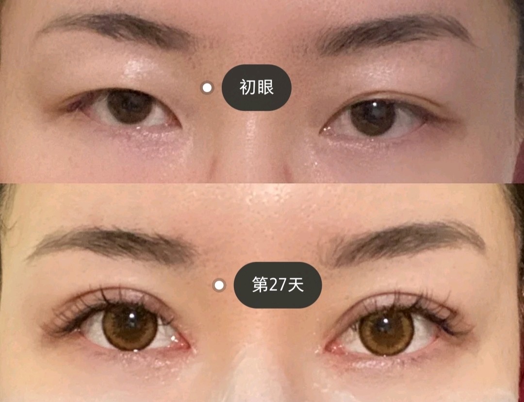 开内眼角会导致斗鸡眼?