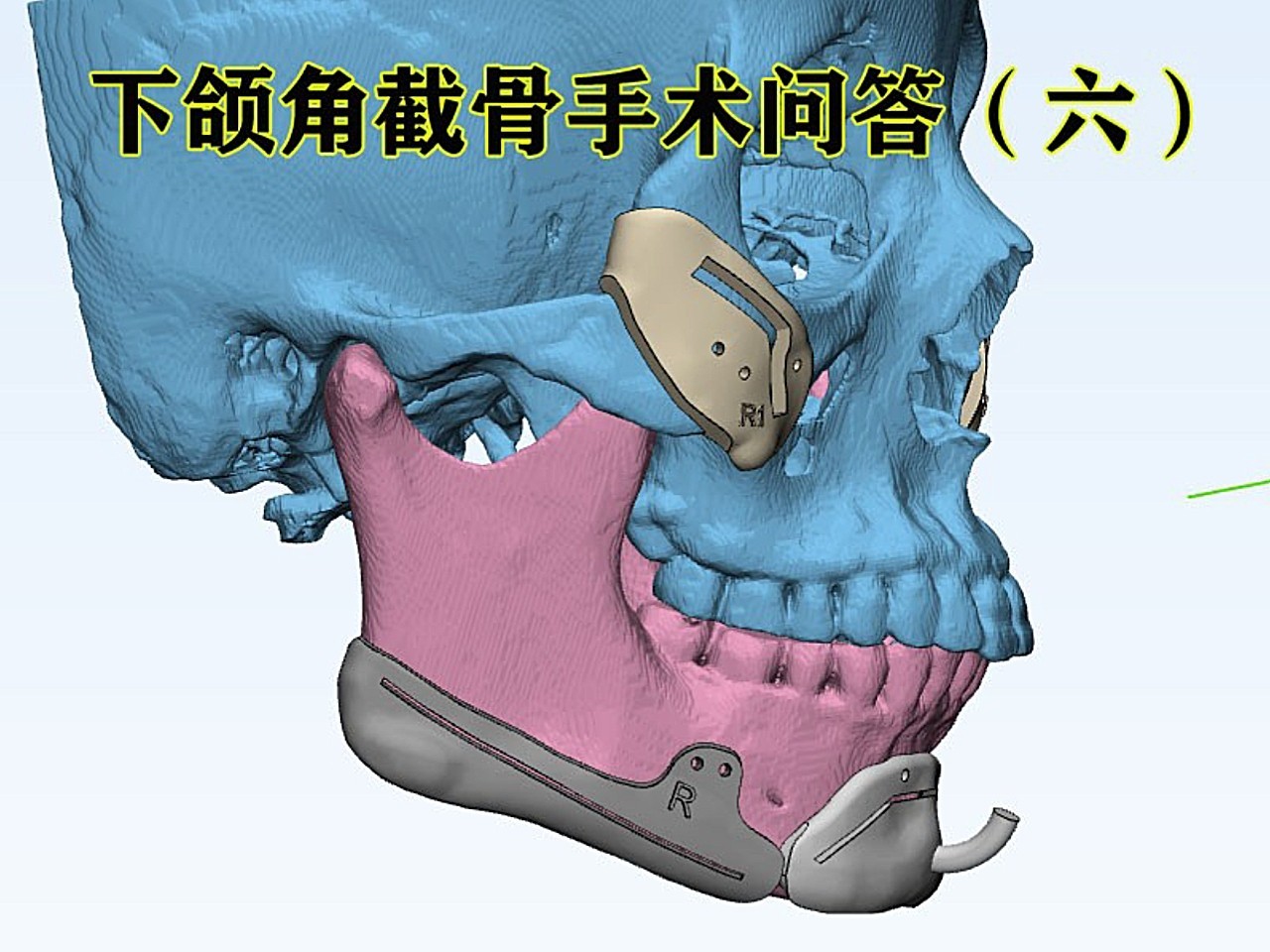 不了度,术后会出现歪嘴神经损伤等 颅颌面手术需要至少6-8年以上的整