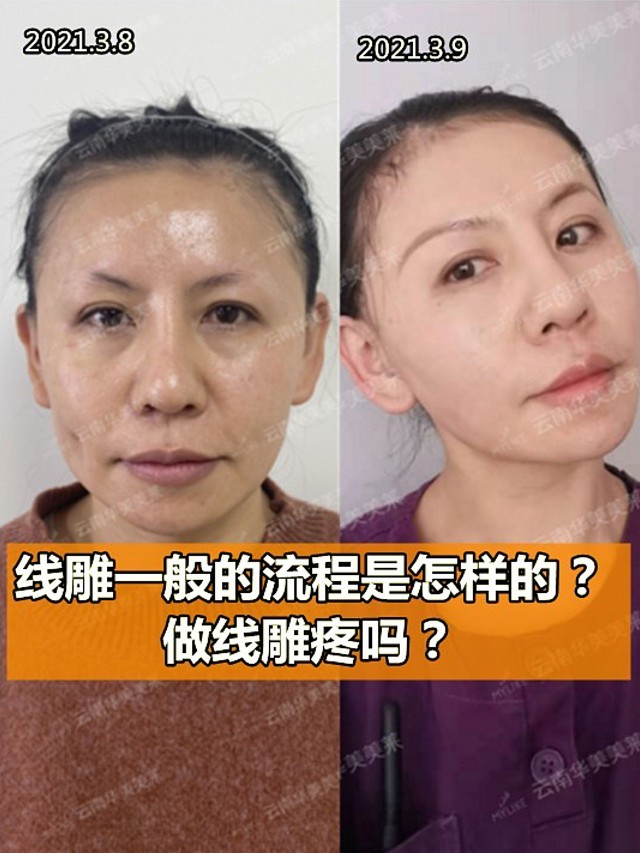 线雕的流程是怎样的?做线雕疼吗?