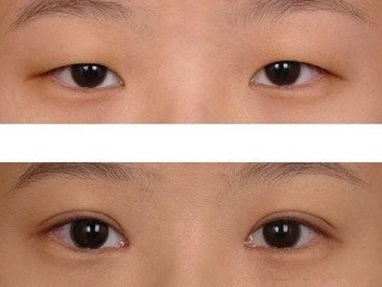 眼睑下垂分为先天和后天两种,先天的眼睑下垂多数都是因为上睑提肌