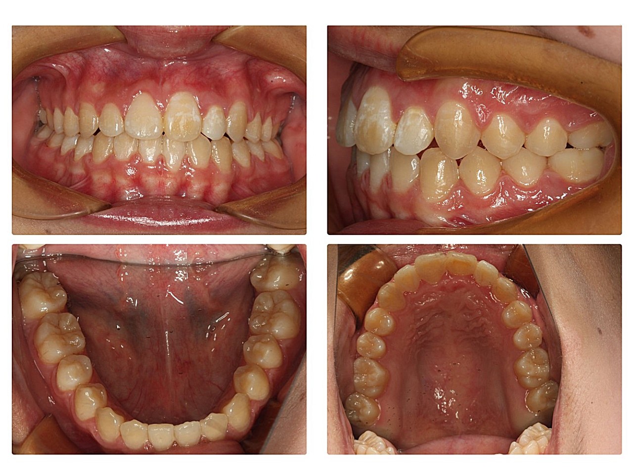 1,乳牙滞留,恒牙萌出异常导致先天缺少一颗门牙