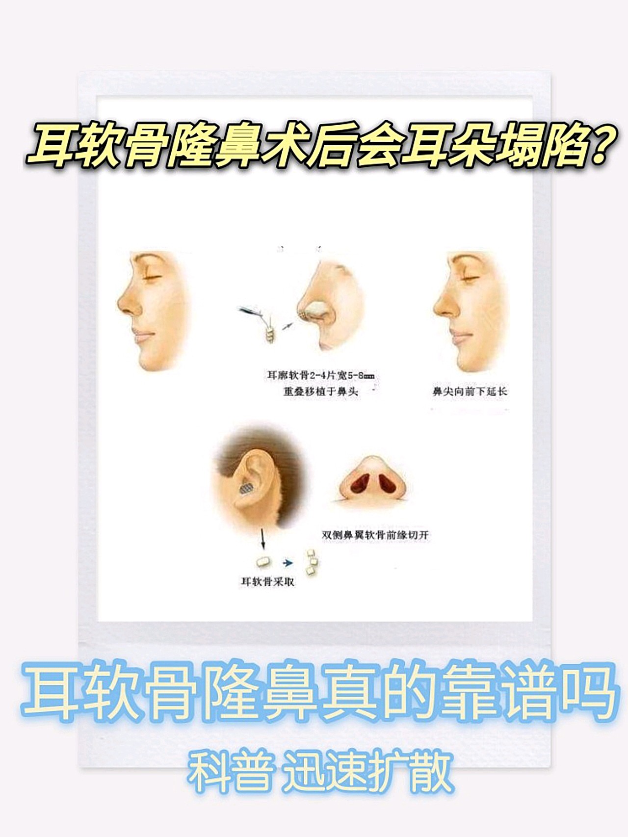 耳软骨隆鼻术后会耳朵塌陷吗