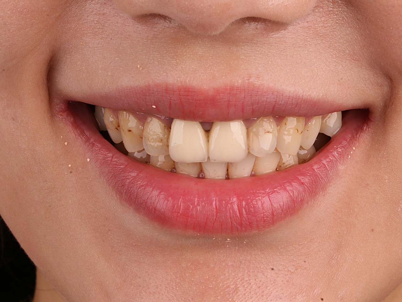 1,树脂贴面脱落,导致牙齿颜色斑驳