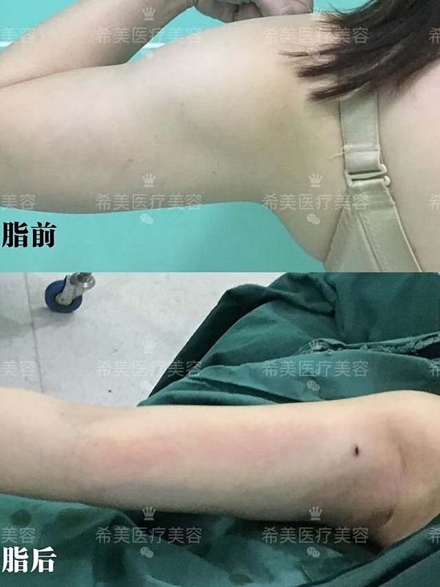 [爱心]#丢掉麒麟臂大象腿 水桶腰