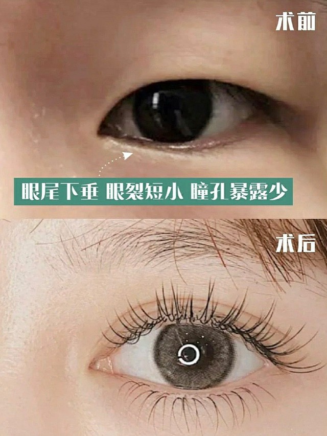 天生眼尾下垂,还有办法挽救吗?
