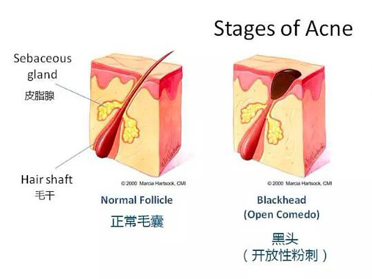 油脂进入毛囊堵塞毛孔,露出皮肤表面的部分被氧化之后_圈子-新氧美容