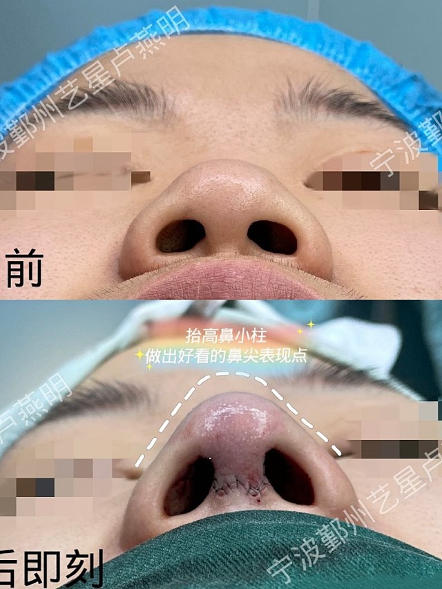 手术方案:自体耳软骨鼻尖成形术,鼻小柱延长,鼻中隔延长,抬高鼻尖,鼻