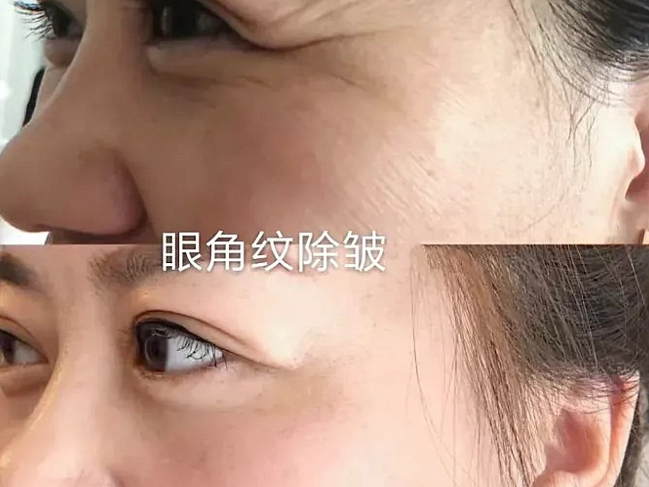 皱纹是怎么长出来的?