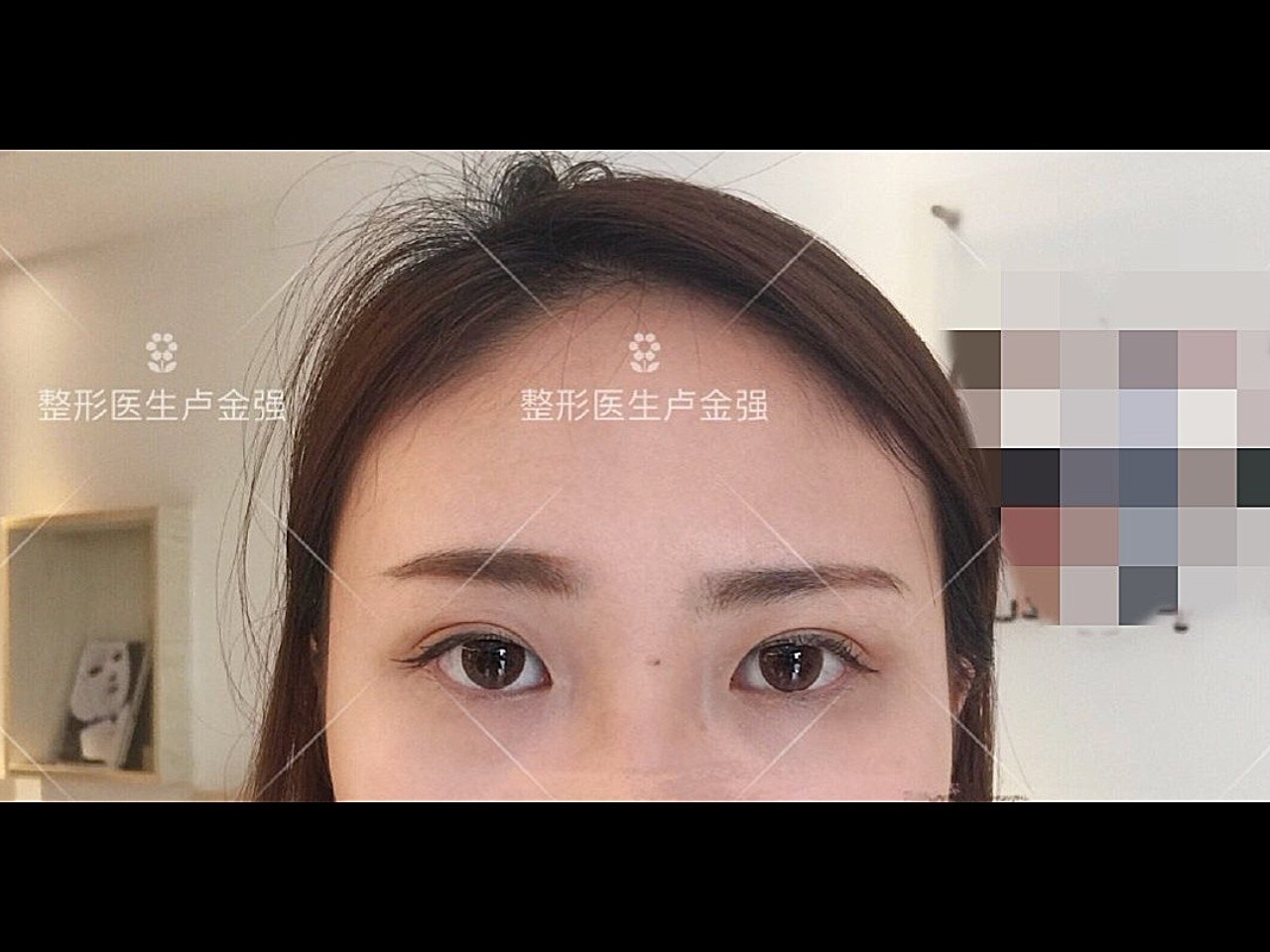 术前小姑娘眼睛无神,眼尾下垂,整个人看起来都没有精神,做完双眼皮后