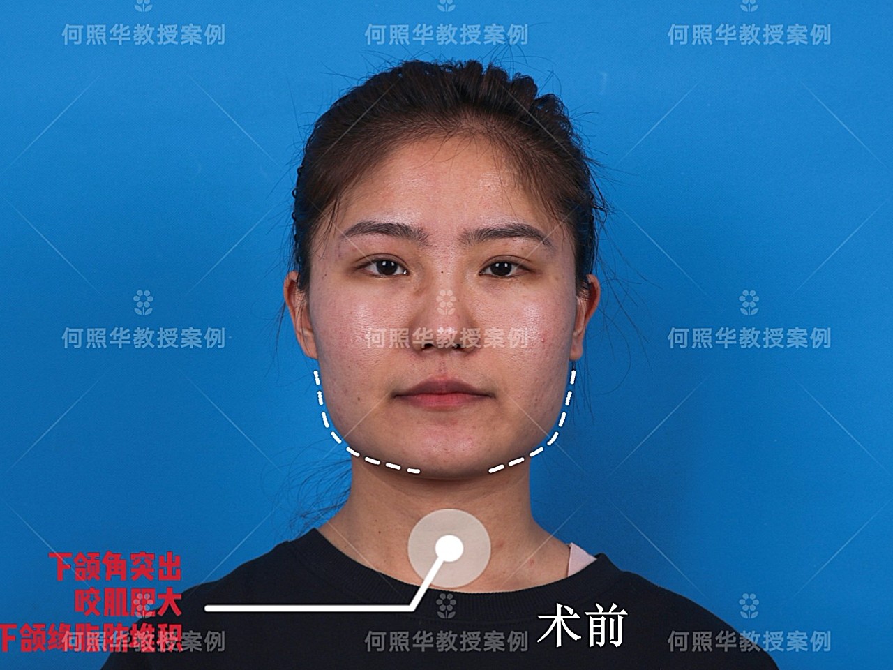 外翻型下颌角做u型截骨,改变大吗?
