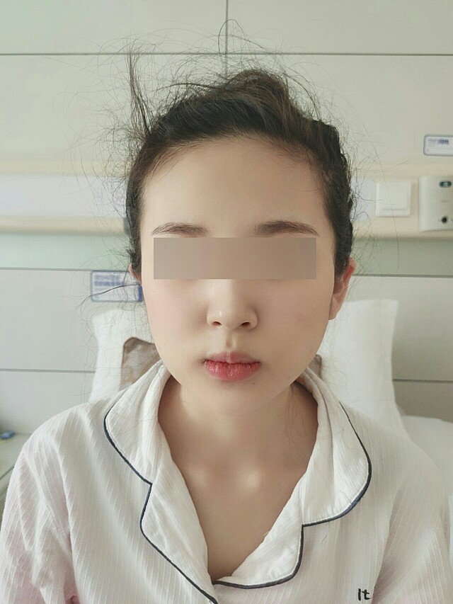 做了下颌角咬肌切除,十分满意,之前我的下颌角很方,_圈子-新氧美容