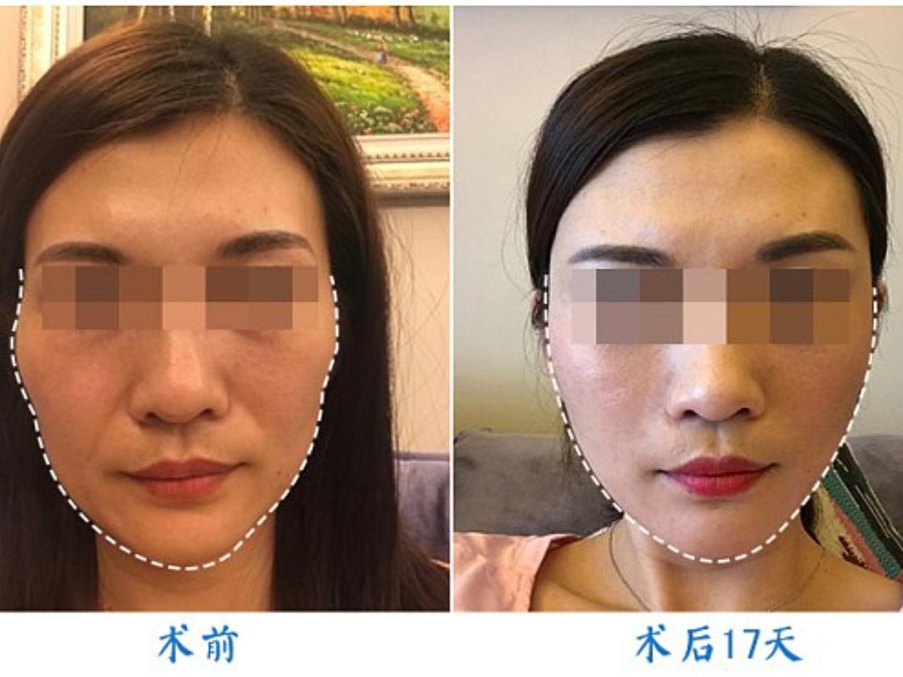 40岁以后,最值得做的整容项目是:拉皮手术icon!