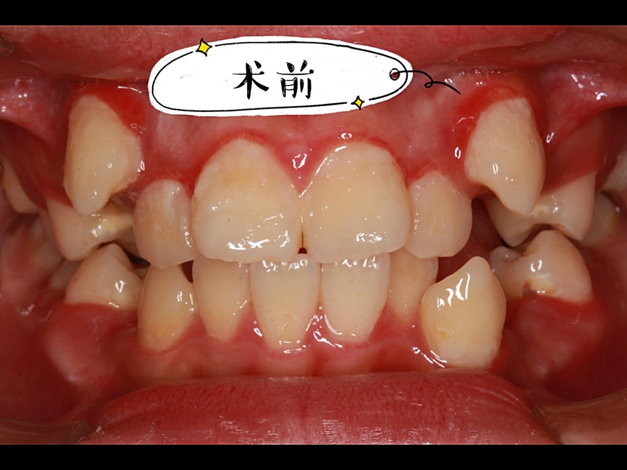 术前诊断求美者术前有虎牙错位,牙齿拥挤,严重不齐