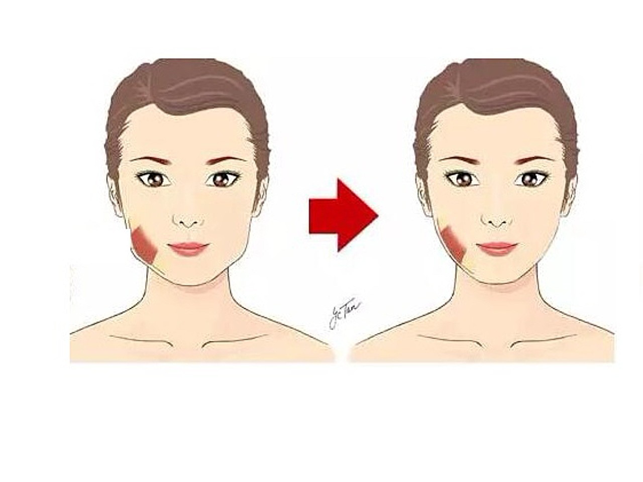 打瘦脸针的过程是怎样的?