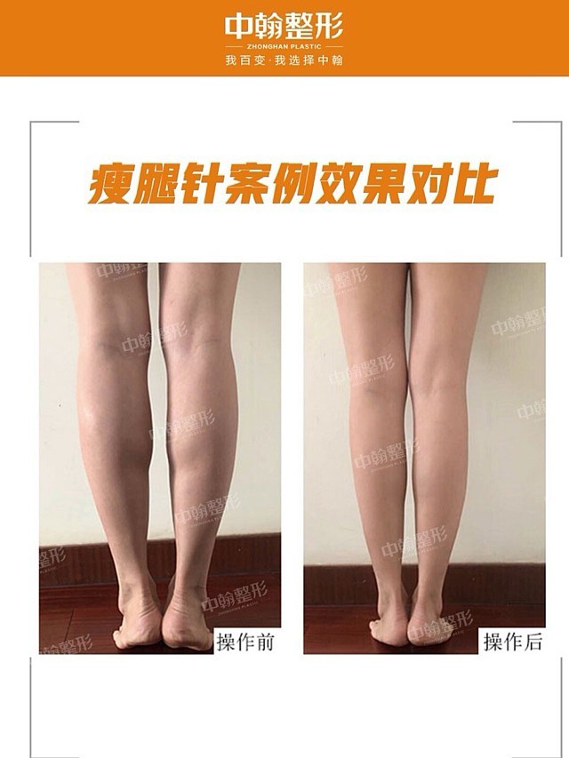 78瘦腿针案例对比789499肌肉腿没了,大腿也细