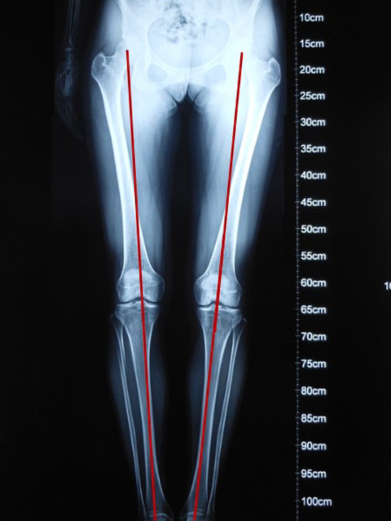 治疗前典型的o型腿,双膝关节内翻畸形,双膝间距大于9cm,腿部外观形态