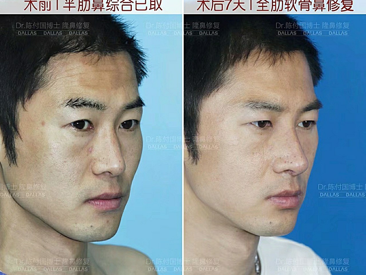 给这个男生修复了鼻子.