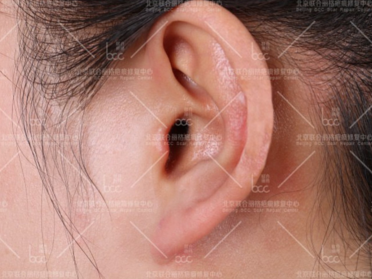 患者因为打耳洞导致疤痕疙瘩,多年后疤痕疙瘩越长越大,皮下有