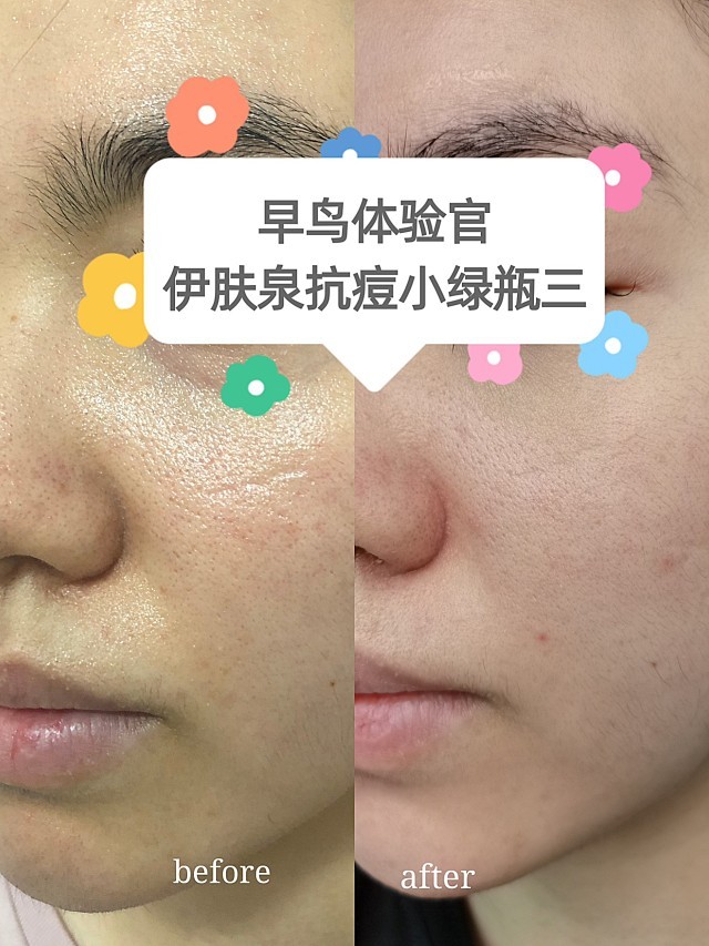 早鸟体验官96伊肤泉抗痘小绿瓶96(三)9797哈喽,大_圈子-新氧