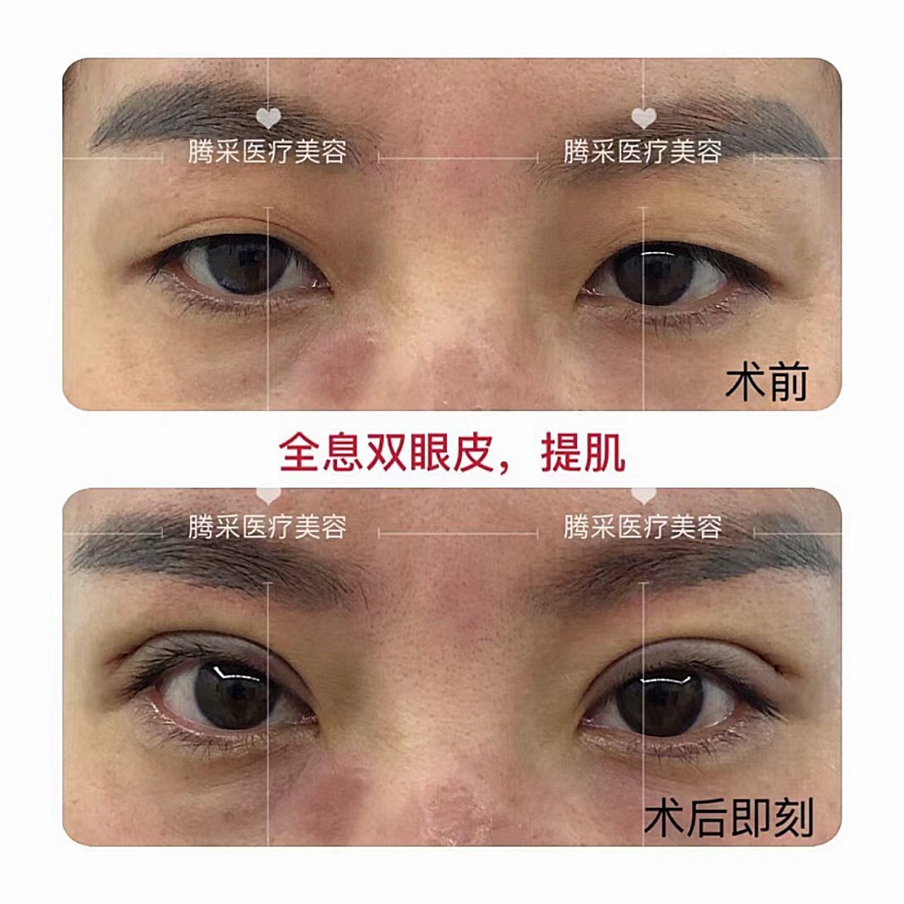 [分享] 單眼外開提眼瞼肌 過程與1個月紀錄 - facelift | PTT消費區