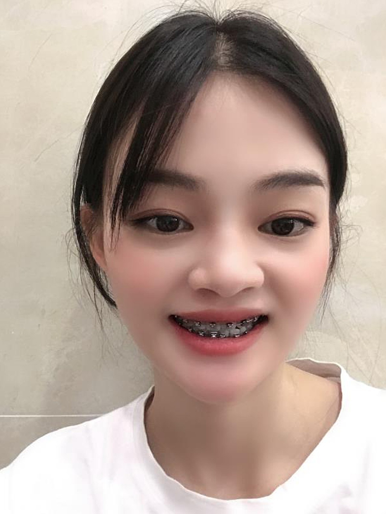 患者牙齿有一些往里凹的趋向,上下牙齿不齐