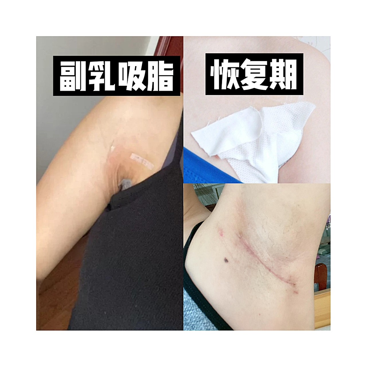 吸脂去副乳案例这才是摆脱尴尬副乳的最好方法