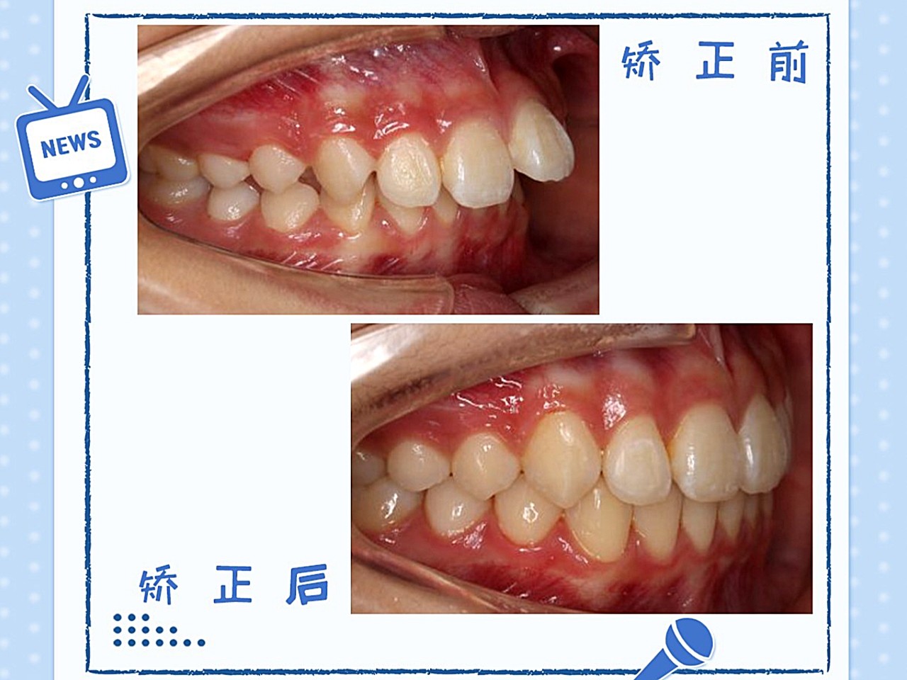 术前诊断医学案例:深覆颌,牙列拥挤方案设计隐形矫正_圈子-新氧美容