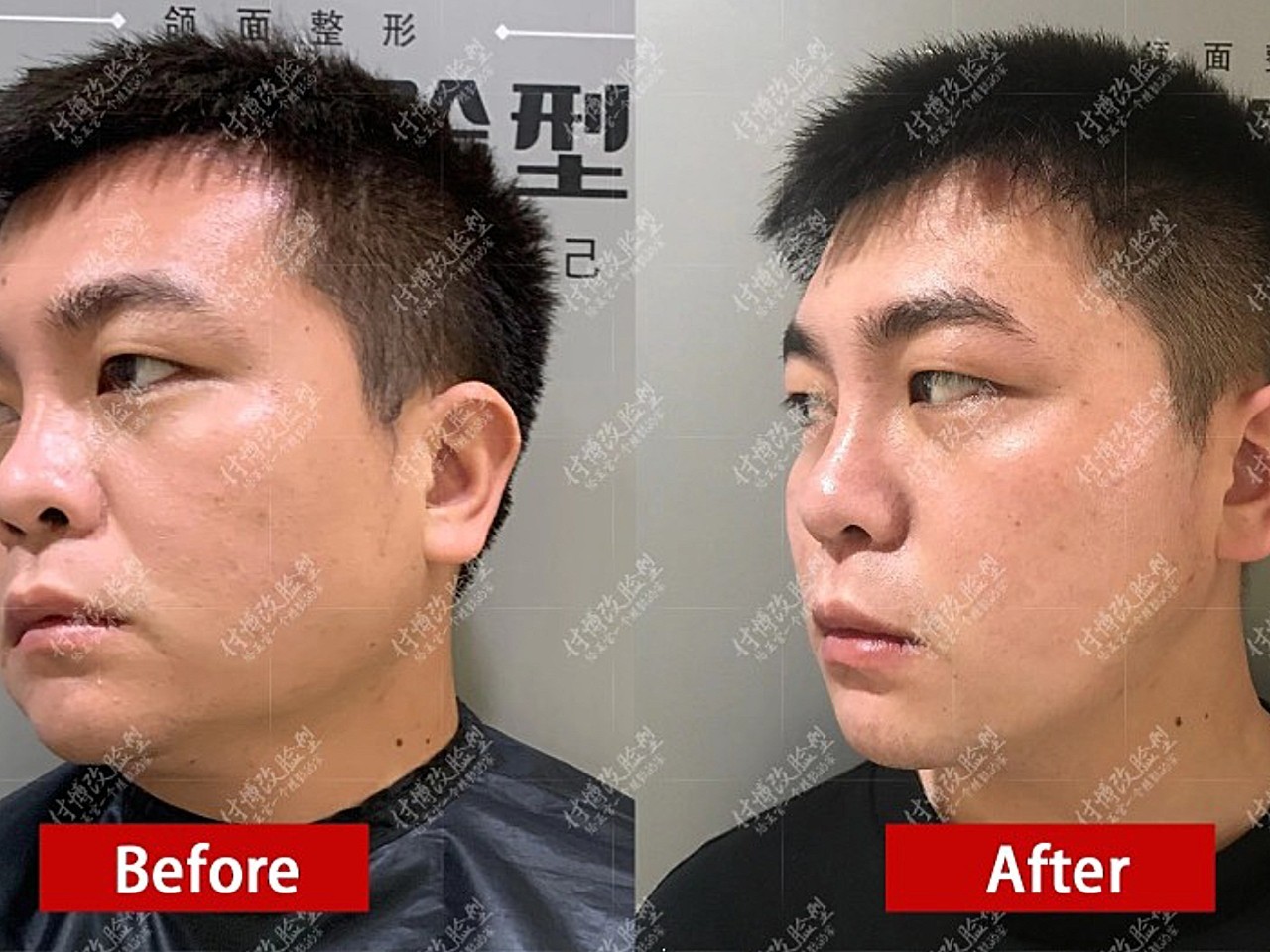 从自然数据上来说,有下颌角骨性肥大或外翻的概率男女